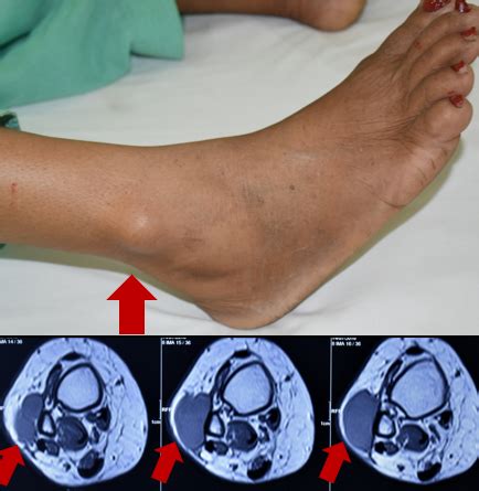 Soft tissue tumors can be cancerous or benign. . Sarcoma pictures legs